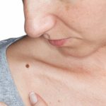 Imagem relacionada a Google Lens agora identifica marcas na pele, como pintas e erupções cutâneas